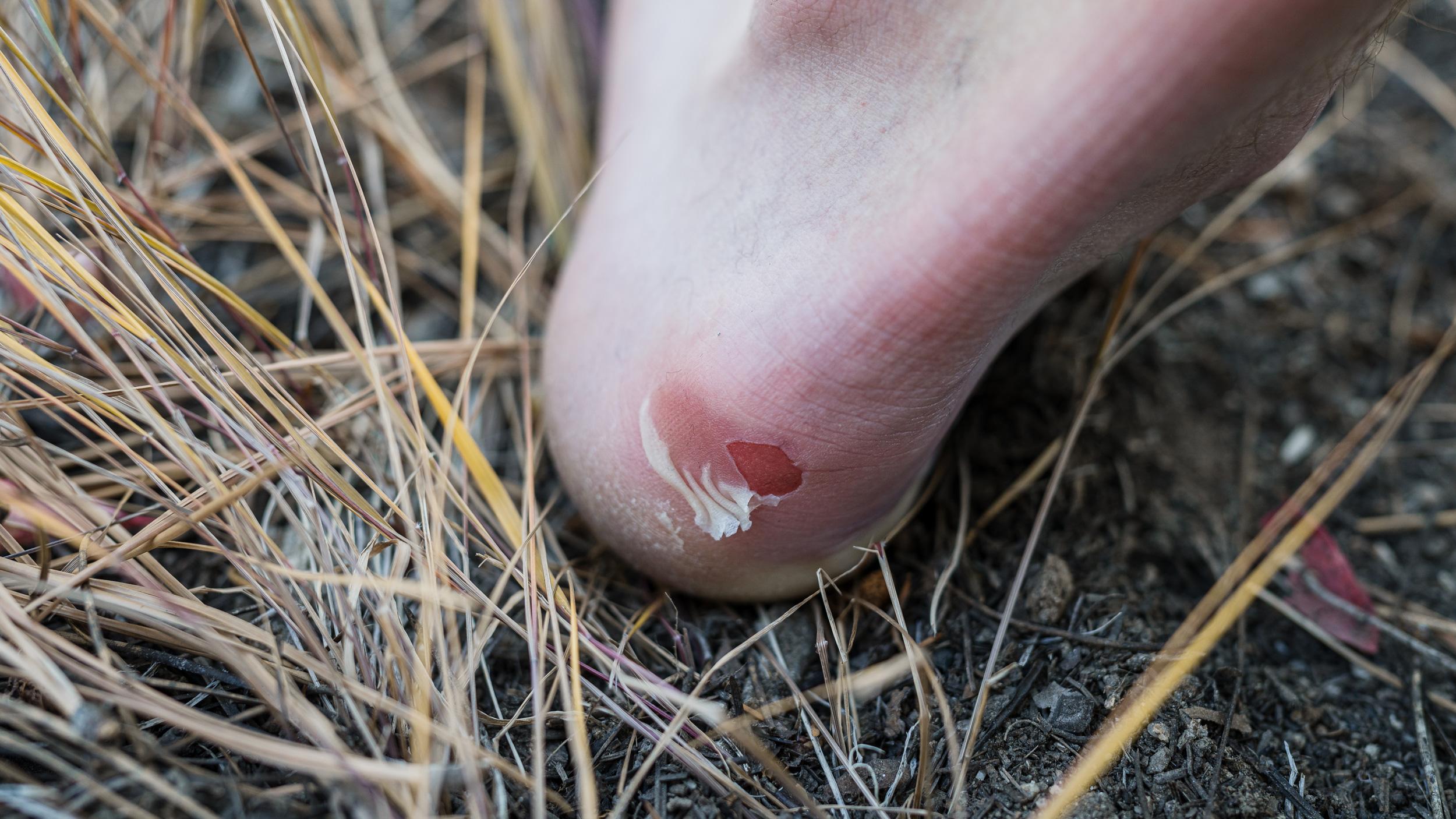 Blister on heel from incorrect hunting boot